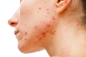 A young women with an acne problem